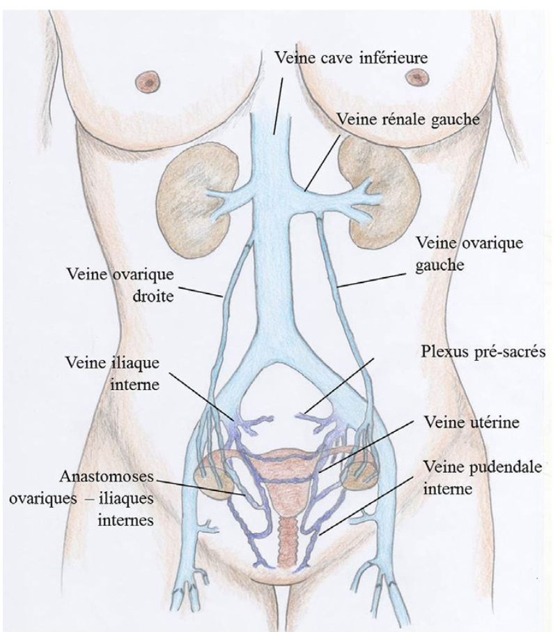 embolisation varices pelvienne veine ovarienne anatomie