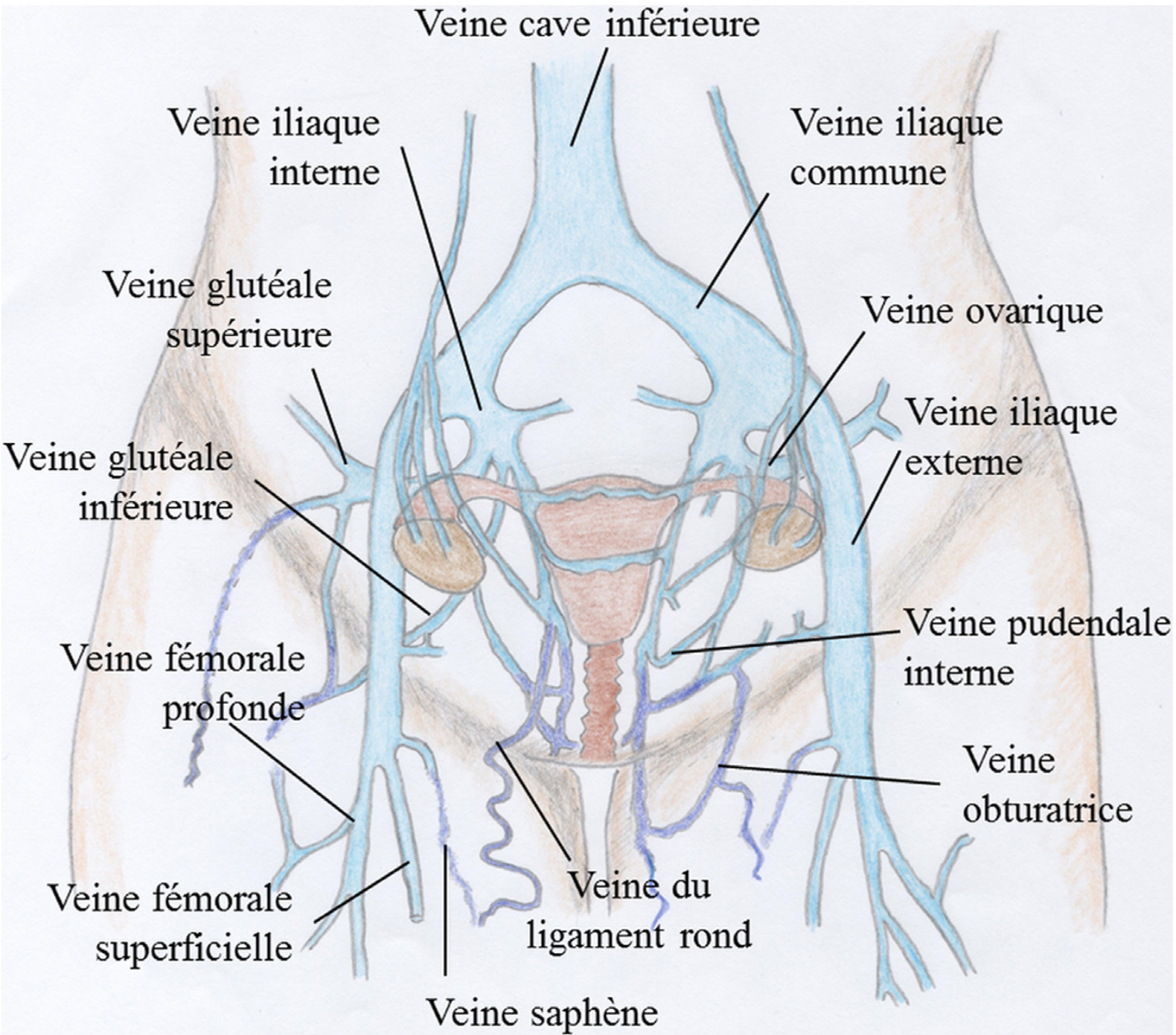 embolisation varice pelvienne veine ovarienne point de fuite