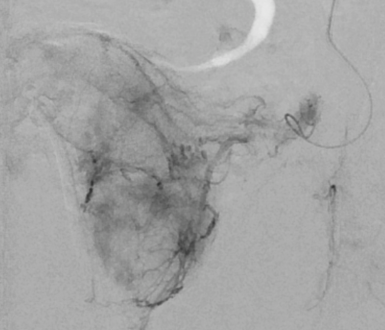 embolisation prostatique cathétérisme hyperselectif artère prostatique gauche