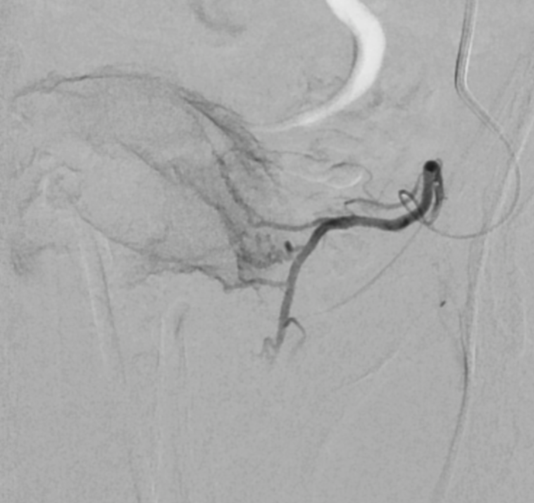 embolisation prostatique artère prostatique cathétérisme hyperselectif