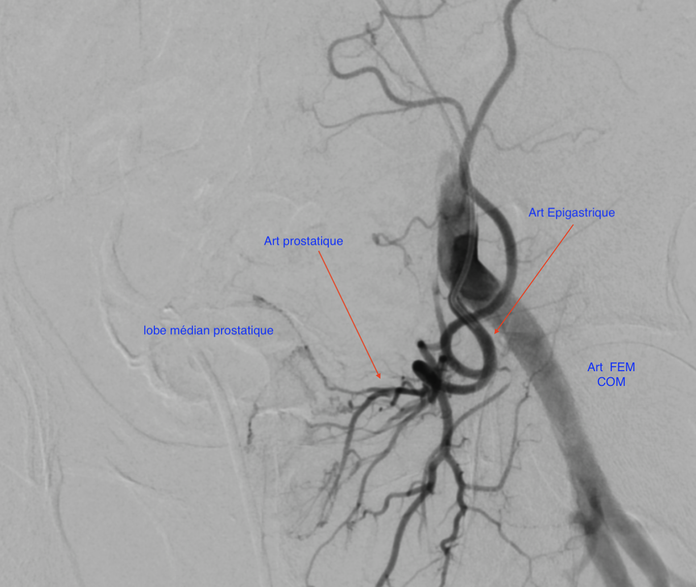 embolisation prostatique artères prostatiques variante anatomique