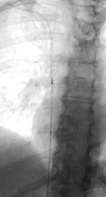 ablation de corps étranger intra vasculaire lasso