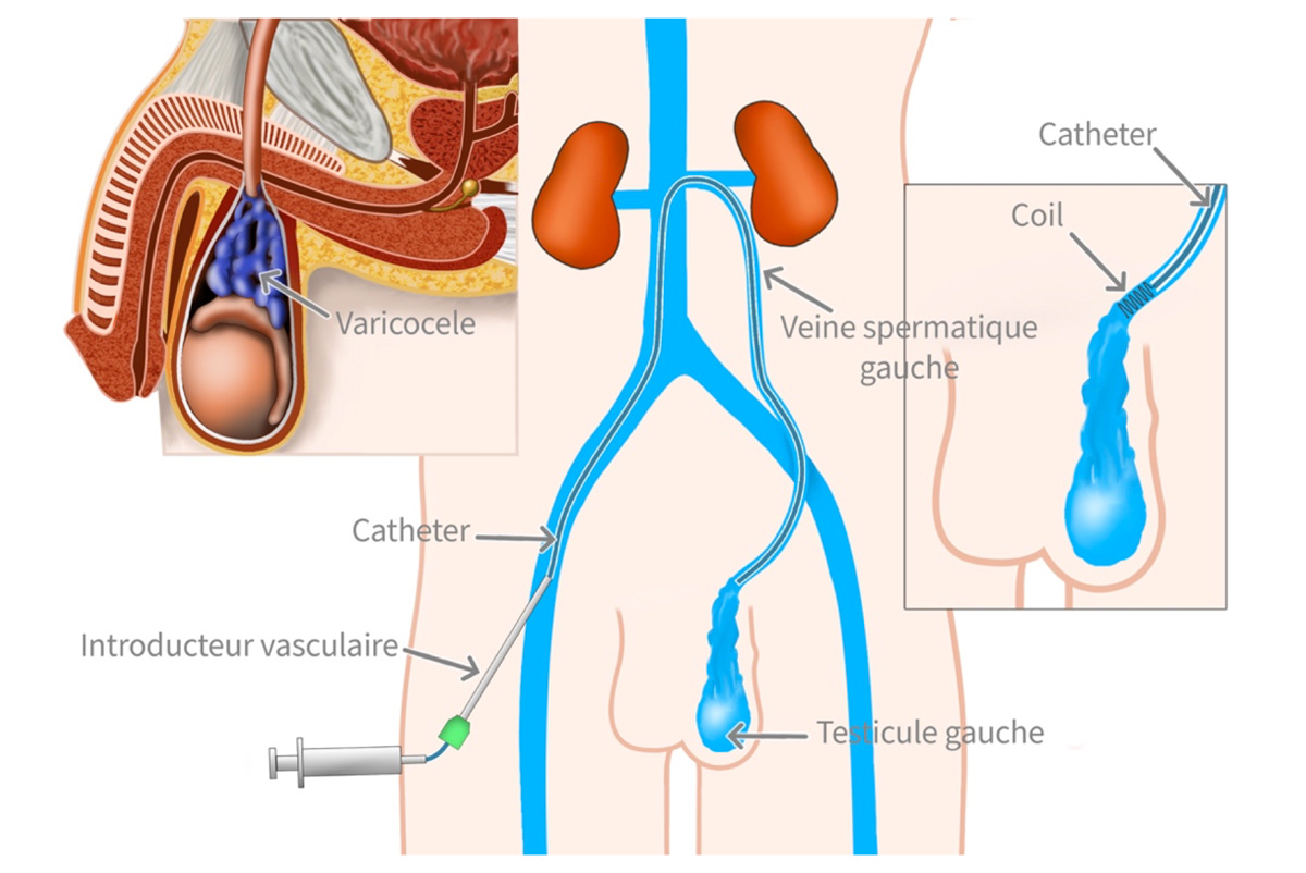 Embolisation de varicocèle