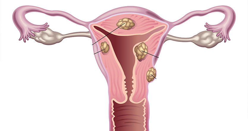 Fibrome utérus