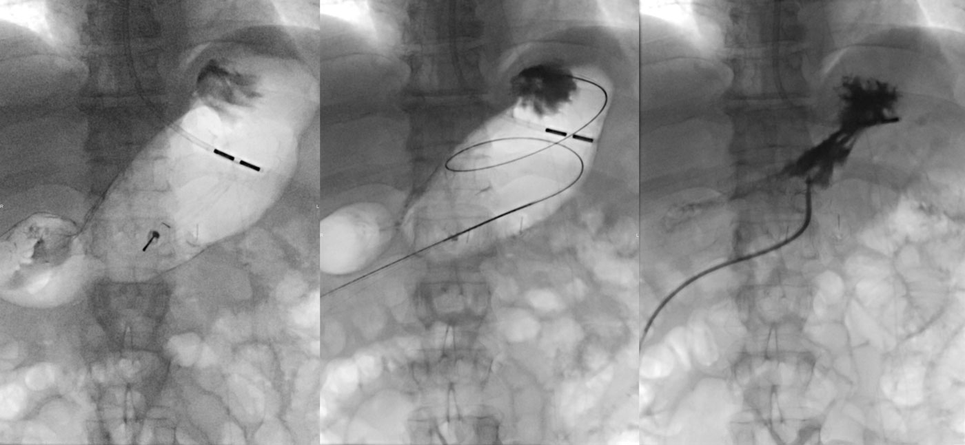 Gastrostomie percutanée