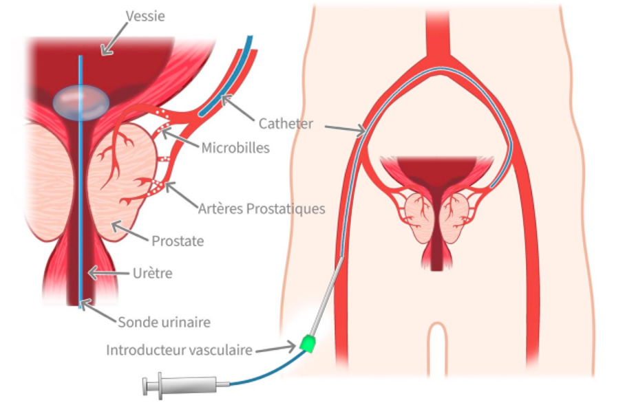 embolisation artères prostatiques prostate microparticules