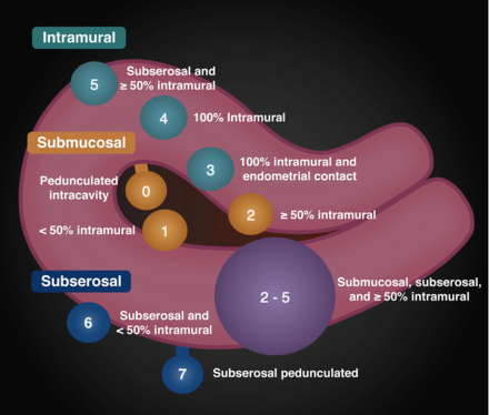 embolisation fibromes utérins types fibromes