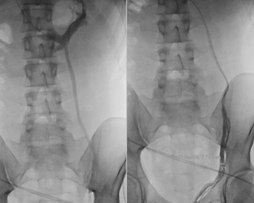 Varicocèle plexiforme complexe