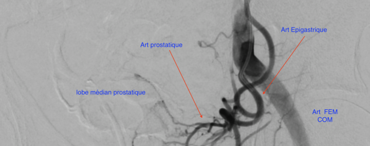 embolisation prostatique artères prostatiques variante anatomique